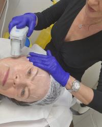 Ultherapy at South William Clinic